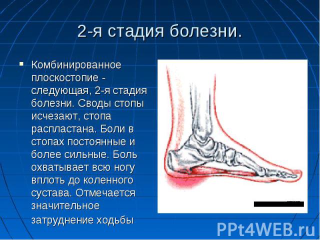 2-я стадия болезни.Комбинированное плоскостопие - следующая, 2-я стадия болезни. Своды стопы исчезают, стопа распластана. Боли в стопах постоянные и более сильные. Боль охватывает всю ногу вплоть до коленного сустава. Отмечается значительное затрудн…