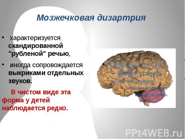 Мозжечковая дизартрия характеризуется скандированной 