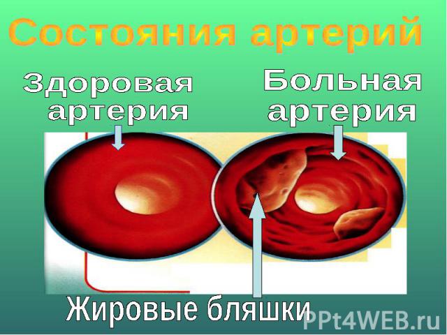 Состояния артерийЗдоровая артерияБольная артерияЖировые бляшки