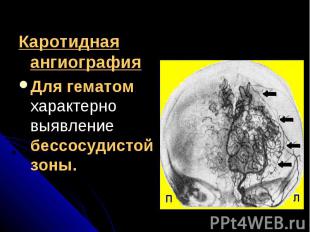 Каротидная ангиографияКаротидная ангиографияДля гематом характерно выявление бес