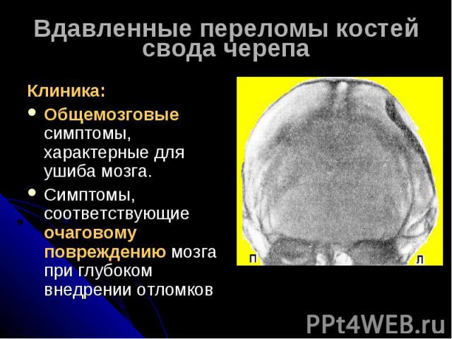 Вдавленные переломы костей свода черепаКлиника:Общемозговые симптомы, характерные для ушиба мозга.Симптомы, соответствующие очаговому повреждению мозга при глубоком внедрении отломков