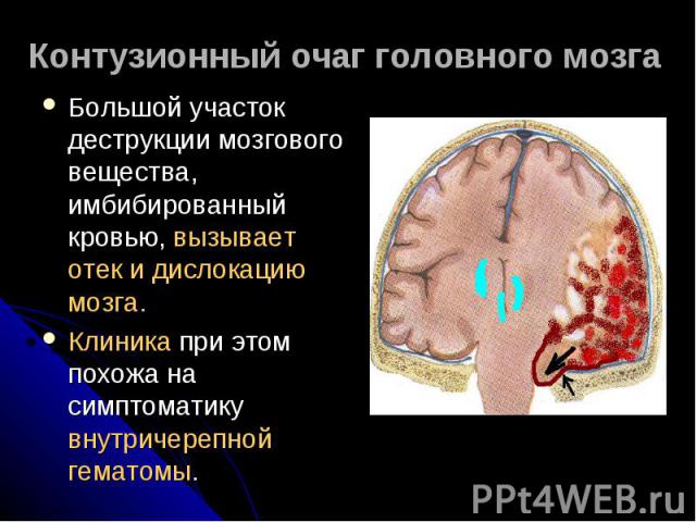 Контузионный очаг головного мозга Большой участок деструкции мозгового вещества, имбибированный кровью, вызывает отек и дислокацию мозга.Клиника при этом похожа на симптоматику внутричерепной гематомы.