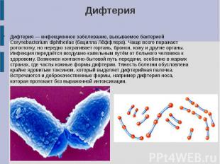 Дифтерия Дифтерия — инфекционное заболевание, вызываемое бактерией Corynebacteri