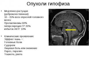 Медленно-растущая (доброкачественная) 10 - 15% всех опухолей головного мозга: Пр