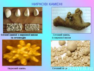 НИРКОВІ КАМЕНІ Сечові камені з ниркової миски Сечовий камінь та сечоводів із нир