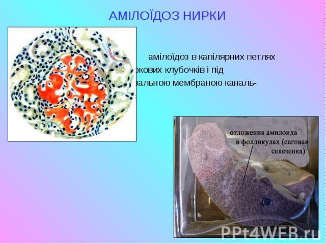 АМІЛОЇДОЗ НИРКИ АМІЛОЇДОЗ НИРКИ амілоїдоз в капілярних петлях ниркових клубочків і під базальною мембраною каналь- ців