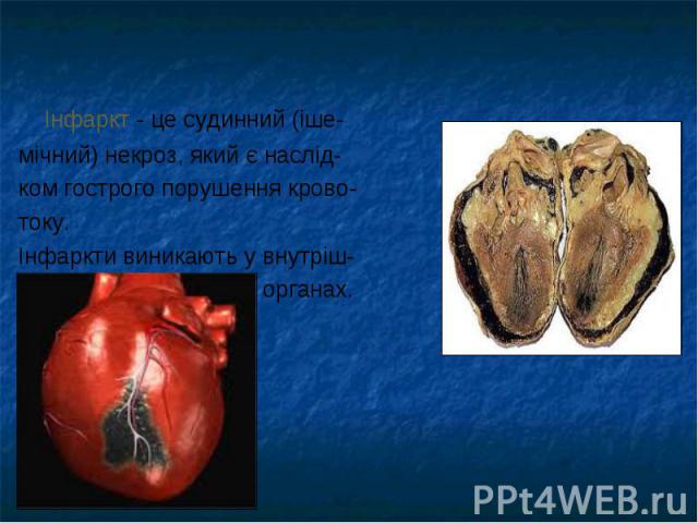 Інфаркт - це судинний (іше- Інфаркт - це судинний (іше- мічний) некроз, який є наслід- ком гострого порушення крово- току. Інфаркти виникають у внутріш- ніх органах.