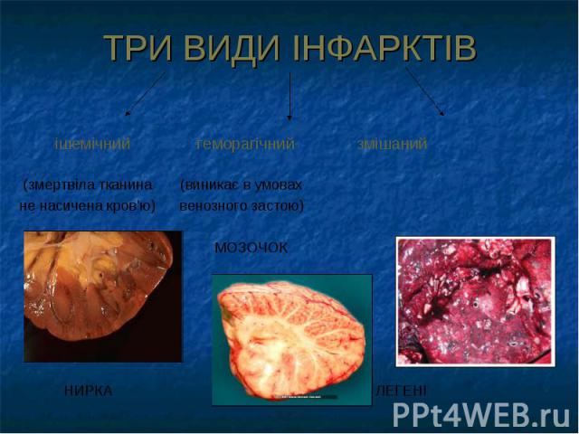 ТРИ ВИДИ ІНФАРКТІВ ішемічний геморагічний змішаний (змертвіла тканина (виникає в умовах не насичена кров'ю) венозного застою) МОЗОЧОК НИРКА ЛЕГЕНІ