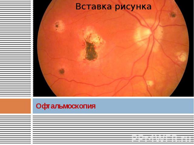 Офтальмоскопия