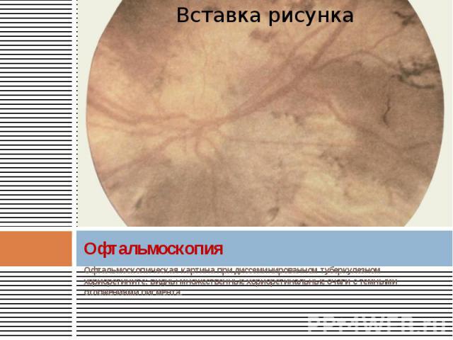 Офтальмоскопия Офтальмоскопическая картина при диссеминированном туберкулезном хориоретините: видны множественные хориоретинальные очаги с темными отложениями пигмента.