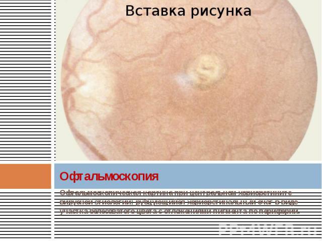 Офтальмоскопия Офтальмоскопическая картина при центральном хориоретините вирусной этиологии: рубцующийся хориоретинальный очаг в виде участка белесоватого цвета с отложениями пигмента по периферии.