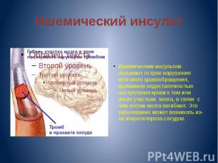 Ишемический инсульт Ишемическим инсультом называют острое нарушение мозгового кр