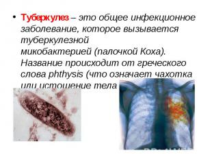 Туберкулез – это общее инфекционное заболевание, которое вызывается туберкулезно