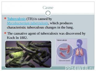 Cause Tuberculosis&nbsp;(TB) is caused by Mycobacterium tuberculosis, which prod