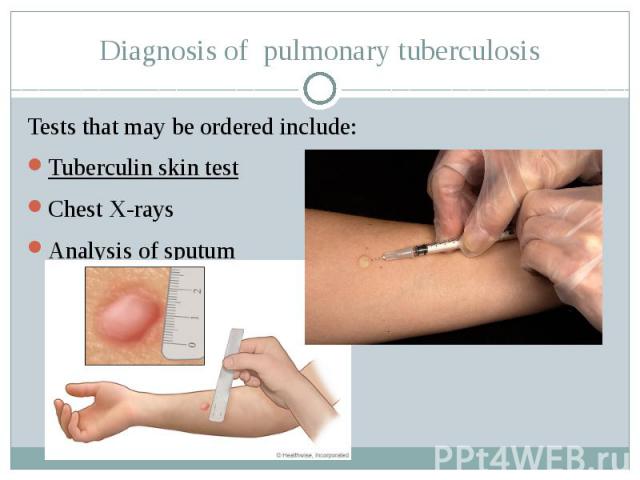 Diagnosis of  pulmonary tuberculosis Tests that may be ordered include: Tuberculin skin test Chest X-rays Analysis of sputum