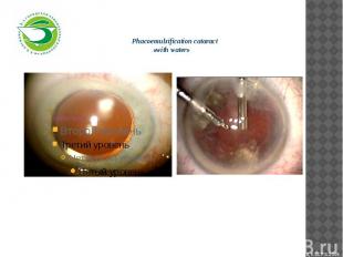 Phacoemulsification cataract «with water»