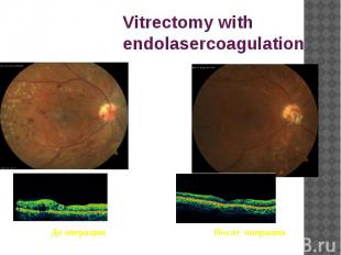 Vitrectomy with endolasercoagulation