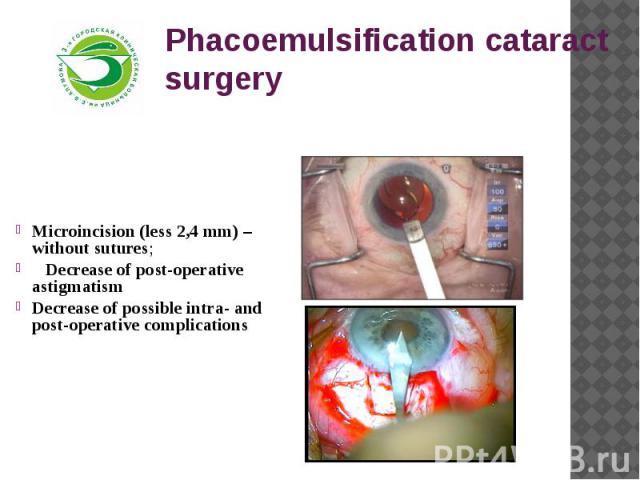 Phacoemulsification cataract surgery Microincision (less 2,4 mm) – without sutures;   Decrease of post-operative astigmatismDecrease of possible intra- and post-operative complications