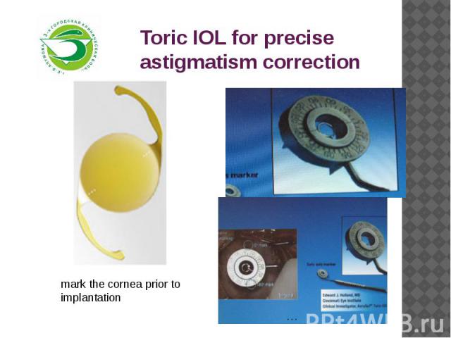 Toric IOL for precise astigmatism correction 