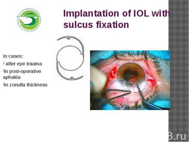 Implantation of IOL with sulcus fixationIn cases: after eye traumain post-operative aphakiain zonulla thickness