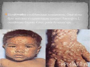 Історія Віспа&nbsp;— одне з найдавніших захворювань. Опис віспи було знайдено в
