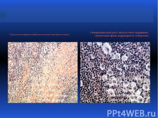Арочные и кольцевидные фиброзные поля при нодулярном склерозе