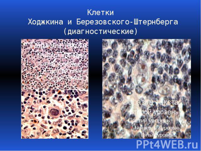 Клетки Ходжкина и Березовского-Штернберга (диагностические)