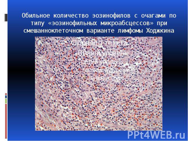 Обильное количество эозинофилов с очагами по типу «эозинофильных микроабсцессов» при смешанноклеточном варианте лимфомы Ходжкина