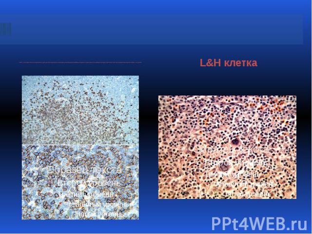 CD20 – позитивные клетки нодулярной структуры при нодулярном лимфоидном преобладании лимфомы Ходжкина: среди малых В-лимфоцитов нодуля единичная L&H клетка (нижняя микрофотография, на стрелке)