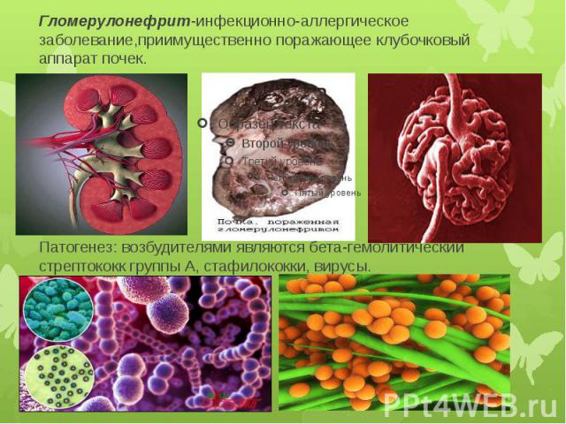 Гломерулонефрит-инфекционно-аллергическое заболевание,приимущественно поражающее клубочковый аппарат почек. Патогенез: возбудителями являются бета-гемолитический стрептококк группы А, стафилококки, вирусы.