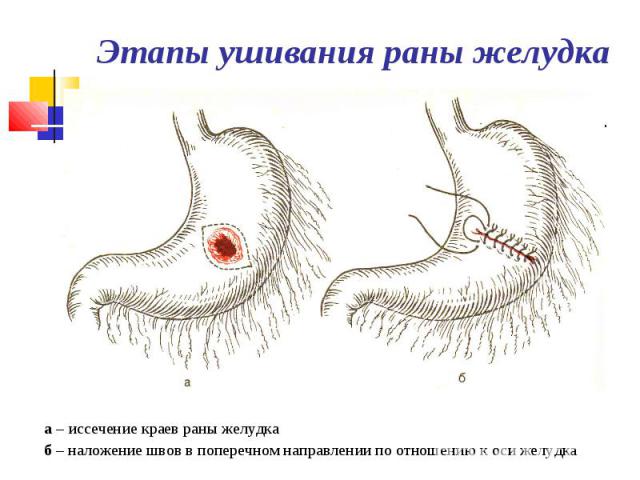 а – иссечение краев раны желудка а – иссечение краев раны желудка б – наложение швов в поперечном направлении по отношению к оси желудка