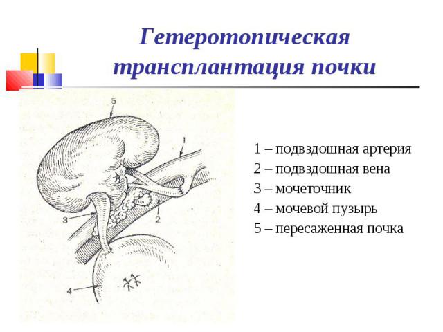 1 – подвздошная артерия 2 – подвздошная вена 3 – мочеточник 4 – мочевой пузырь 5 – пересаженная почка