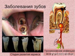 Заболевания зубов