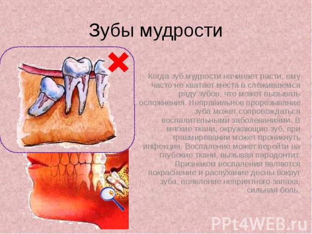 Зубы мудрости Когда зуб мудрости начинает расти, ему часто не хватает места в сложившемся ряду зубов, что может вызывать осложнения. Неправильное прорезывание зуба может сопровождаться воспалительными заболеваниями. В мягкие ткани, окружающие зуб, п…