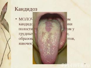 МОЛОЧНИЦА, одна из форм кандидоза слизистой оболочки полости рта, главным образо