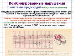 Нарушение сердечного ритма, при котором наблюдается частое (350-700/мин) и хаоти