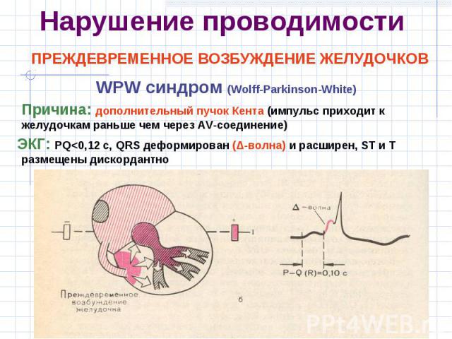 WPW синдром (Wolff-Parkinson-White) WPW синдром (Wolff-Parkinson-White) Причина: дополнительный пучок Кента (импульс приходит к желудочкам раньше чем через AV-соединение) ЭКГ: PQ<0,12 с, QRS деформирован (Δ-волна) и расширен, ST и T размещены дис…