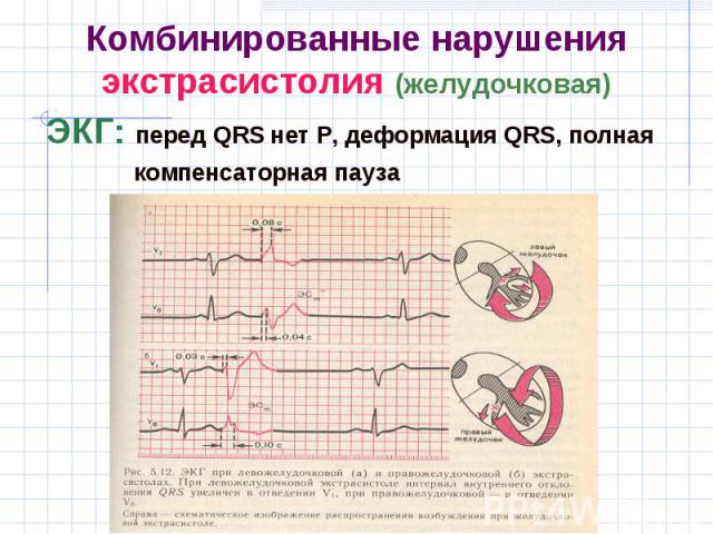 ЭКГ: перед QRS нет Р, деформация QRS, полная ЭКГ: перед QRS нет Р, деформация QRS, полная компенсаторная пауза