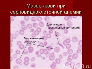 Мазок крови при серповидноклеточной анемии