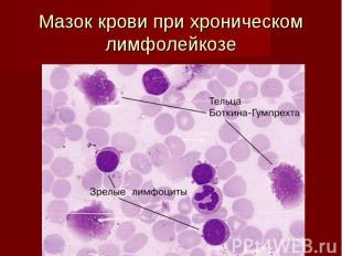 Мазок крови при хроническом лимфолейкозе
