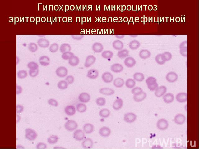 Гипохромия и микроцитоз эритороцитов при железодефицитной анемии