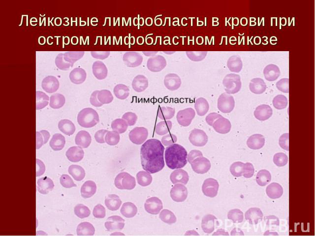 Лейкозные лимфобласты в крови при остром лимфобластном лейкозе