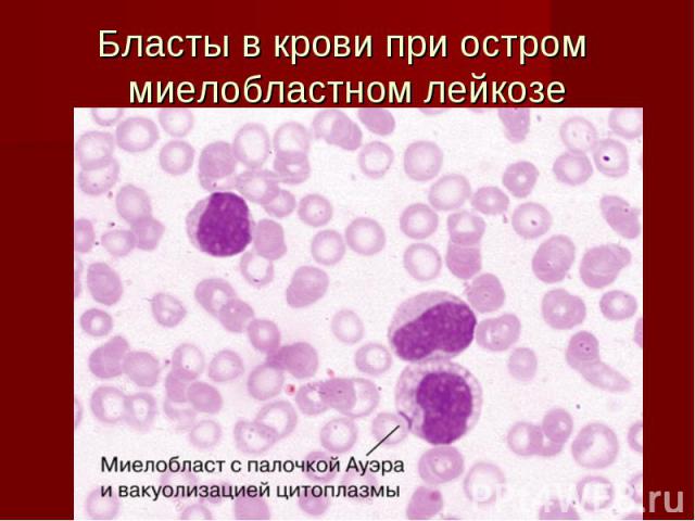 Бласты в крови при остром миелобластном лейкозе