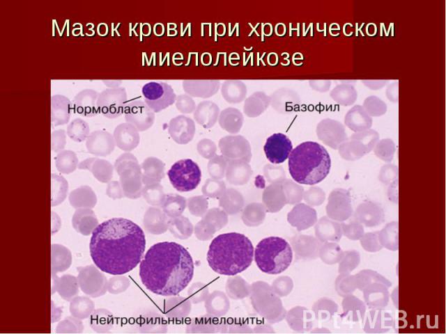 Мазок крови при хроническом миелолейкозе
