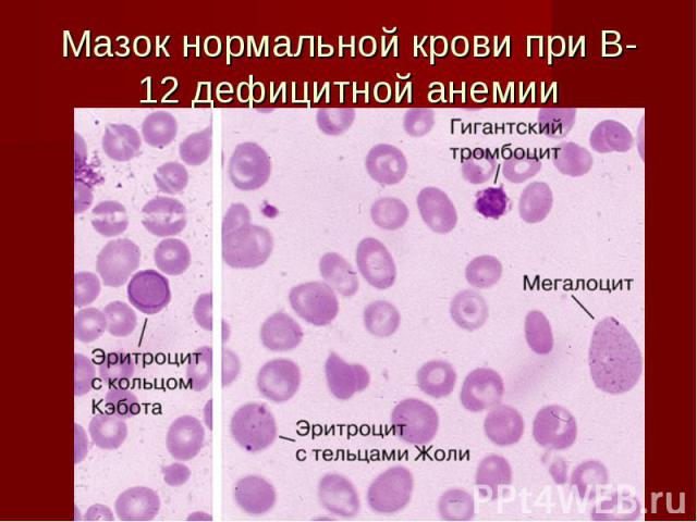 Мазок нормальной крови при В-12 дефицитной анемии