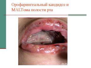 Орофарингеальный кандидоз и MALTома полости рта
