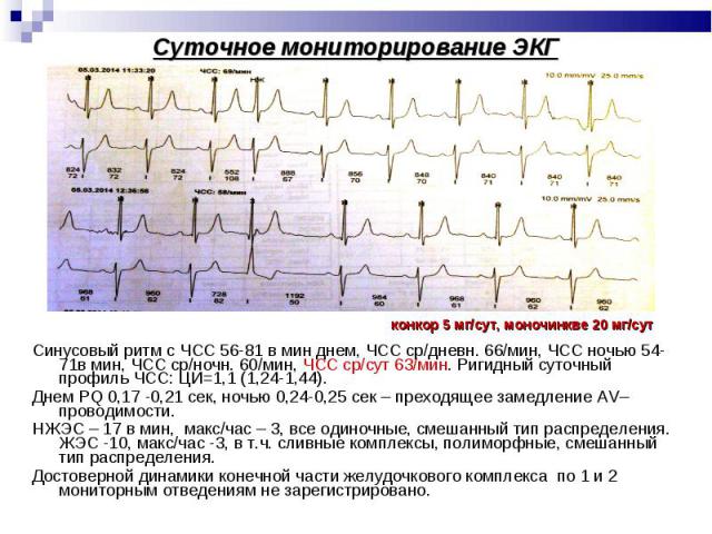 Синусовый ритм с ЧСС 56-81 в мин днем, ЧСС ср/дневн. 66/мин, ЧСС ночью 54-71в мин, ЧСС ср/ночн. 60/мин, ЧСС ср/сут 63/мин. Ригидный суточный профиль ЧСС: ЦИ=1,1 (1,24-1,44). Днем PQ 0,17 -0,21 сек, ночью 0,24-0,25 сек – преходящее замедление AV–пров…