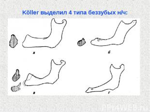 Köller выделил 4 типа беззубых н/ч: Köller выделил 4 типа беззубых н/ч: