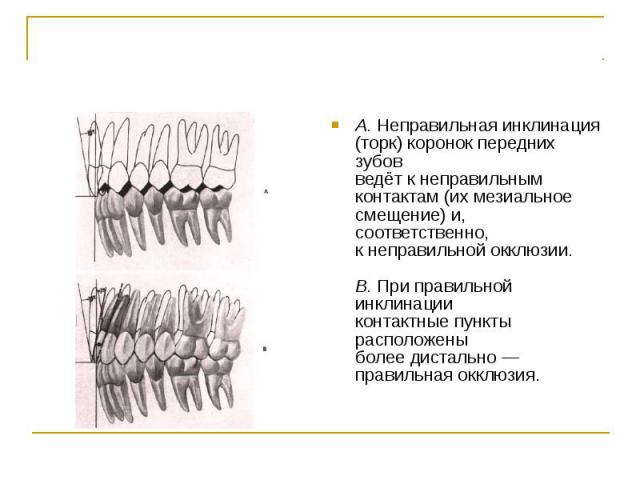 А. Неправильная инклинация (торк) коронок передних зубов ведёт к неправильным контактам (их мезиальное смещение) и, соответственно, к неправильной окклюзии. В. При правильной инклинации контактные пункты расположены более дистально — правильная оккл…