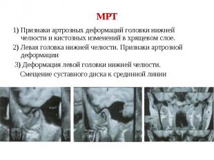 1) Признаки артрозных деформаций головки нижней челюсти и кистозных изменений в